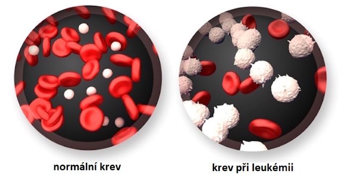 porovnn normln krve a krve pi leukmii