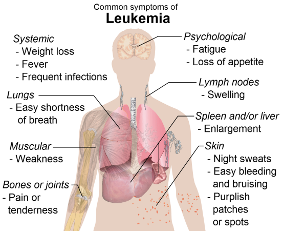 Symptomy leukemie